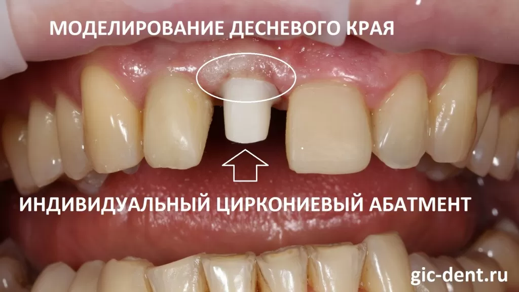 На фото выше вы видите временные коронки на передних резцах 1.2 и 2.1, а области зуба 1.1 вы можете видеть установленный индивидуальный циркониевый абатмент